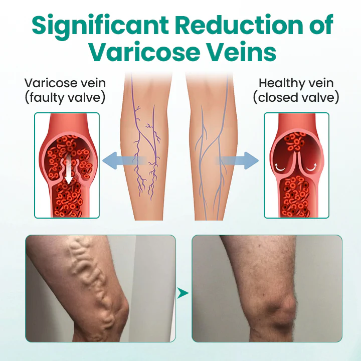 Healrize® LegRenew Varicose Veins Patch✨ - Image 6