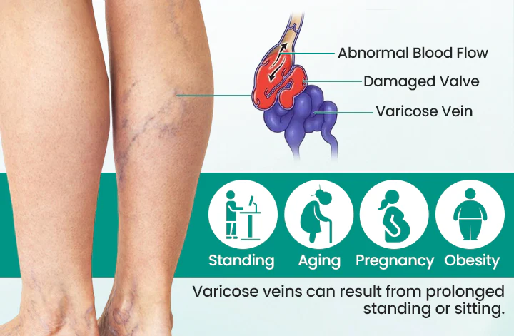 Healrize® LegRenew Varicose Veins Patch✨ - Image 7