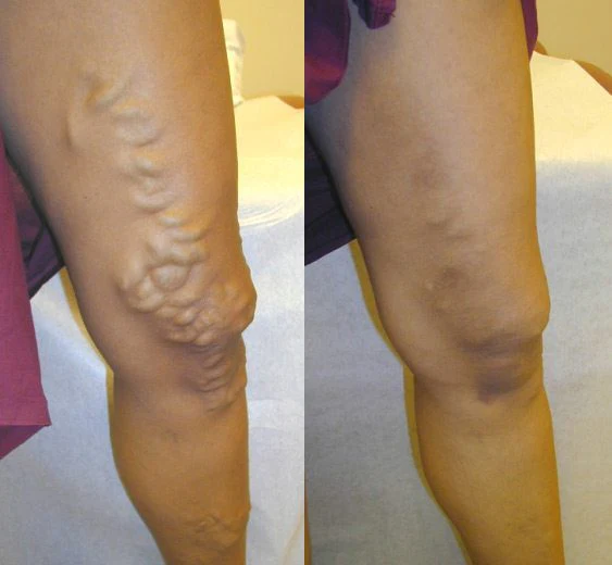 Healrize® LegRenew Varicose Veins Patch✨ - Image 9